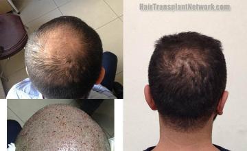 Hair restoration procedure before and after pictures