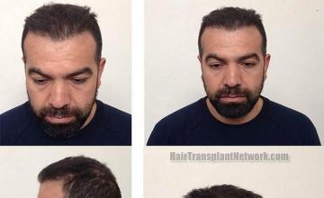 Hair restoration surgery before and after photographs