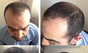 Hair transplantation surgery before photos