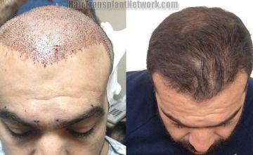 Hair restoration procedure immediate postoperative and after pictures