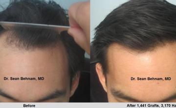 Frontal before and after hair transplant