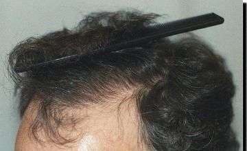 Hair restoration procedure results