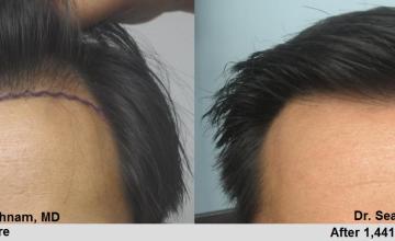 Front of patient before and after FUE of 1441 grafts