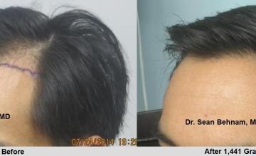 Left side before and after hair transplant