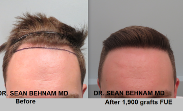 Before and after FUE surgery 1900 grafts