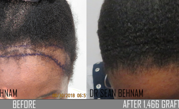 Before and after FUE surgery 1466 grafts