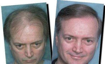 Hair restoration procedure results