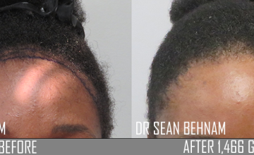 Front of patient before and after FUE of 1466 grafts