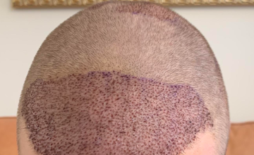 Graft placement in hairline, midscalp and crown