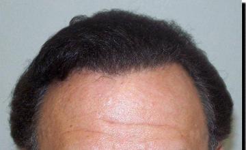 Hair restoration procedure results