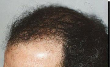 Hair restoration procedure results