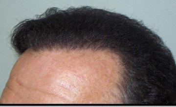 Hair restoration procedure results