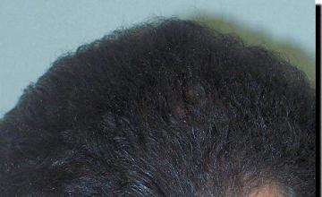 Hair restoration procedure results