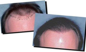 Hair restoration procedure results