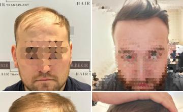Before and After