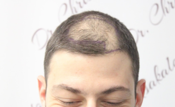 Before