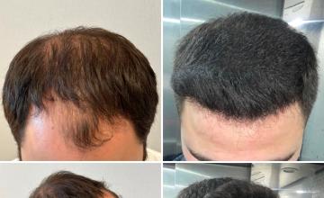 Before and After