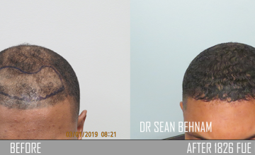 Before and after FUE hair transplant