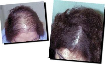 Hair restoration procedure results