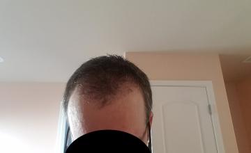 Two months post-op hairline