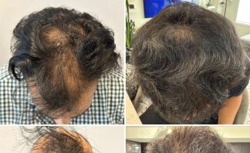 Before and After