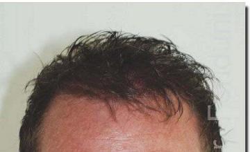 Hair restoration procedure results