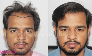 Dr. Suneet Soni | Hair transplant before and after photos