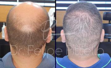 Back of Patient before and after FUE surgery