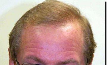 Hair restoration procedure results