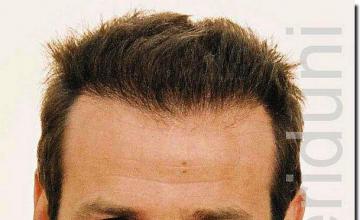 Hair restoration procedure results