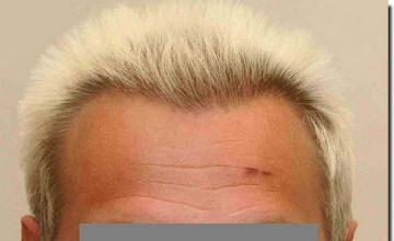 Hair restoration procedure results