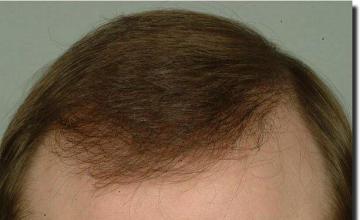 Hair restoration procedure results