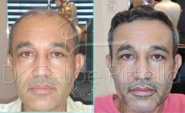 Frontal area before and after hair transplant surgery