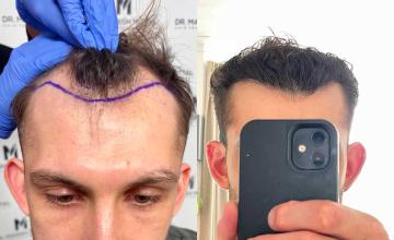 Front before and after FUE surgery