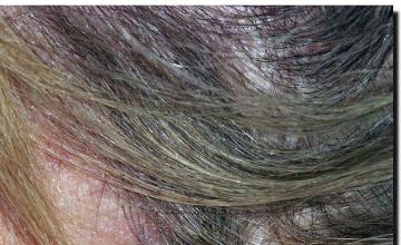 Hair restoration procedure results