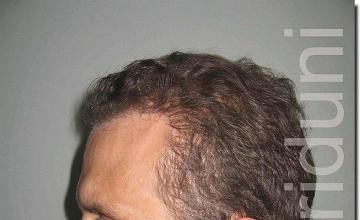 Hair restoration procedure results