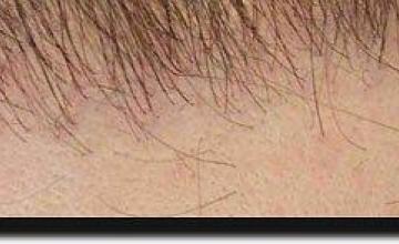 Hair restoration procedure results