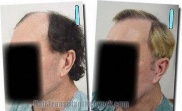 Hair restoration procedure results