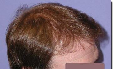 Hair restoration procedure results