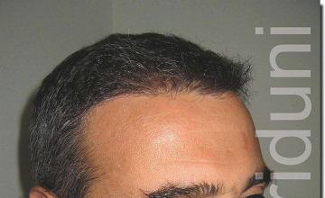 Hair restoration procedure results