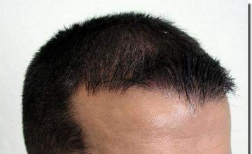 Hair restoration procedure results