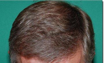 Hair restoration procedure results