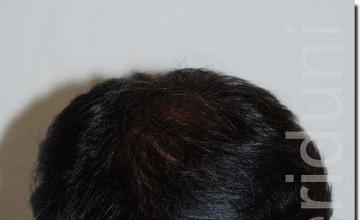 Hair restoration procedure results