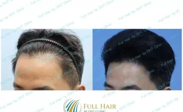 Before after