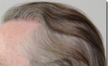 Hair restoration procedure results