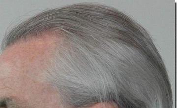 Hair restoration procedure results