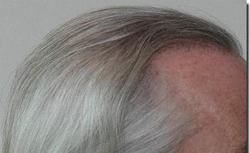 Hair restoration procedure results