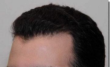 Hair restoration procedure results