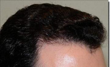 Hair restoration procedure results