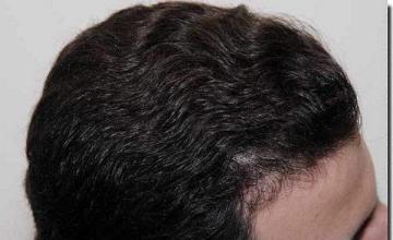 Hair restoration procedure results